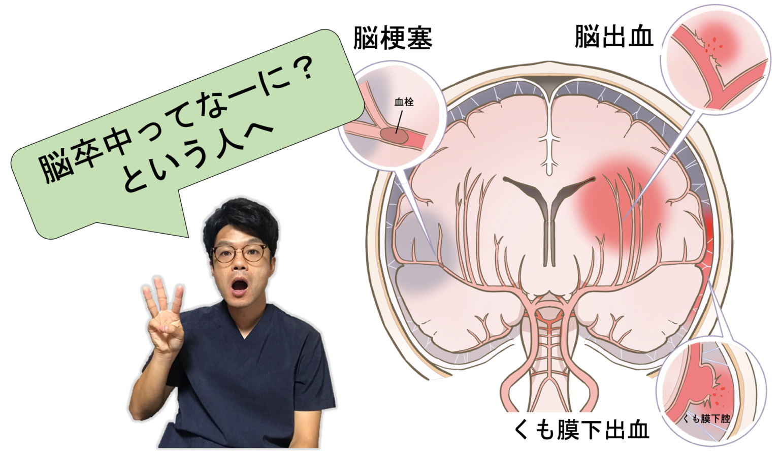多発性脳卒中は余命にどのような影響を与えるのでしょうか?
